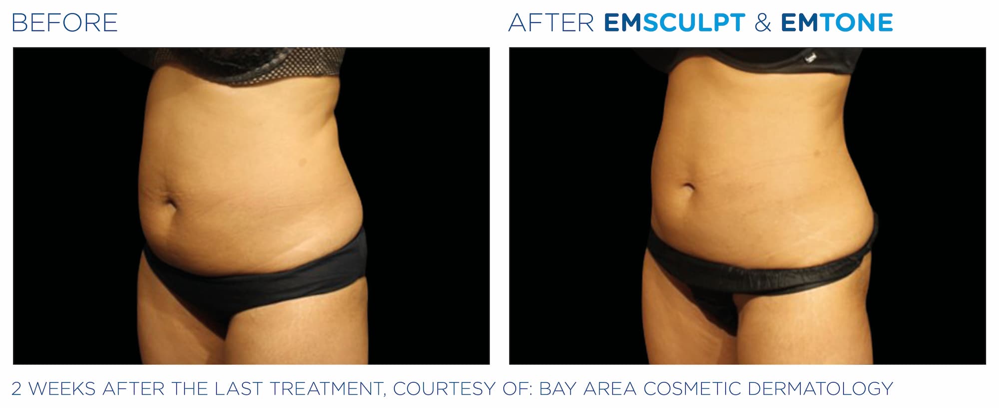 Emsculpt_Emtone_PIC_001_Ba-card-female-abdomen_ENUS100