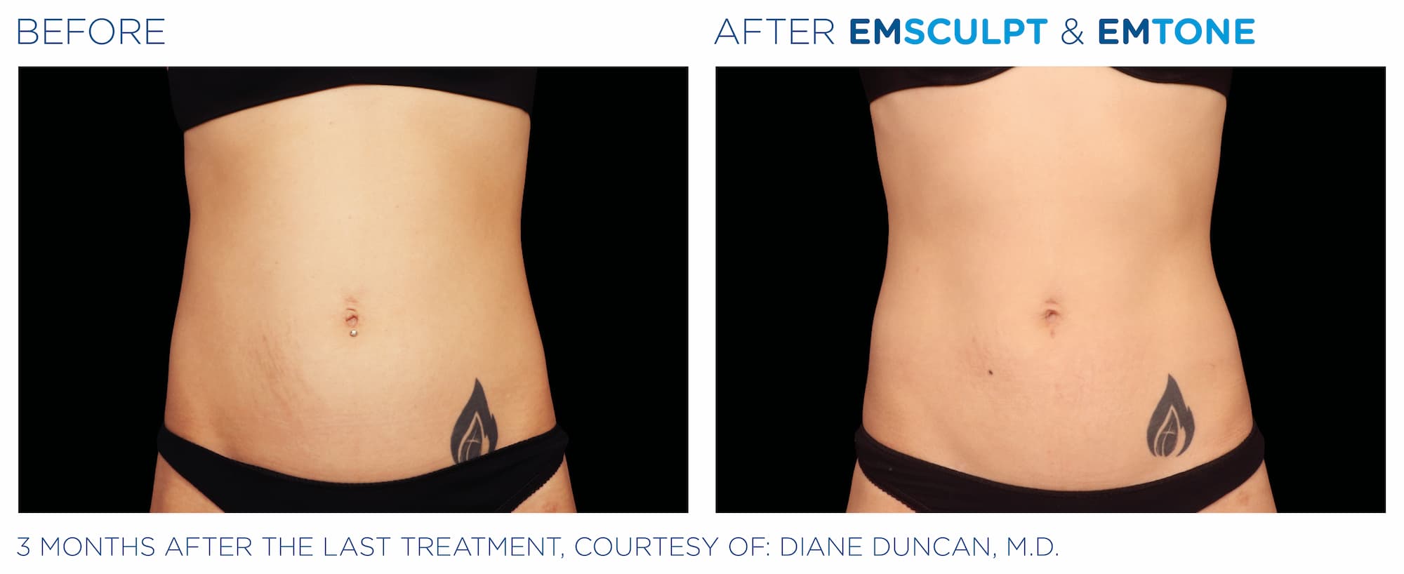 Emsculpt_Emtone_PIC_Ba-card-female-abdomen-022_ENUS100