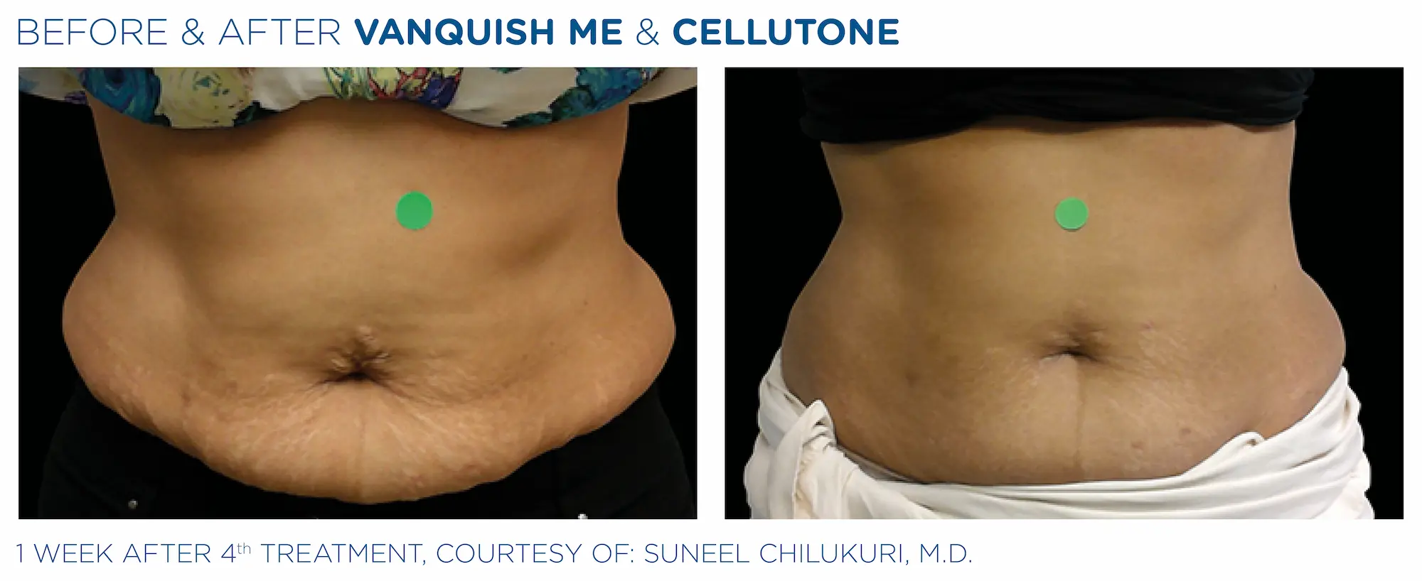 Vanquish_ME-Cellutone_PIC_Ba-card-female-abdomen-002_ENUS100 (1)